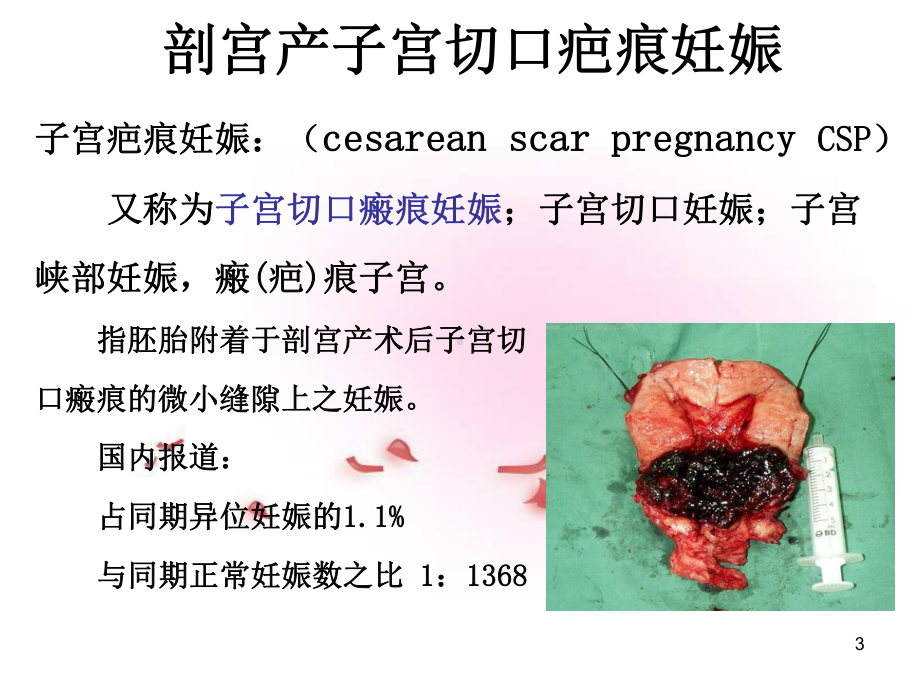 疤痕妊娠的影像学诊断PPT课件.ppt_第3页