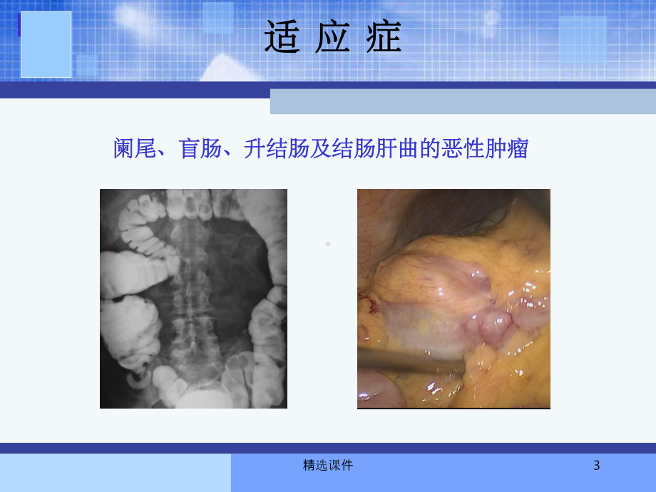 腹腔镜右半结肠切除术ppt课件.ppt_第3页