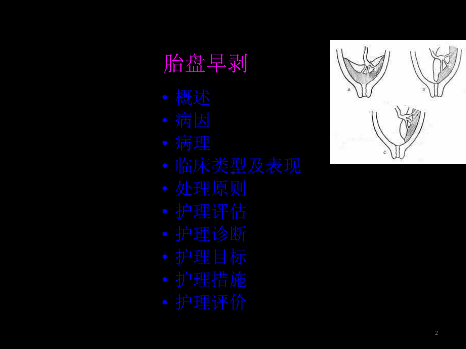 胎盘早剥护理ppt课件.ppt_第2页