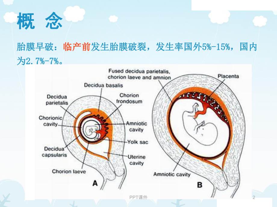 胎膜早破-ppt课件.ppt_第2页