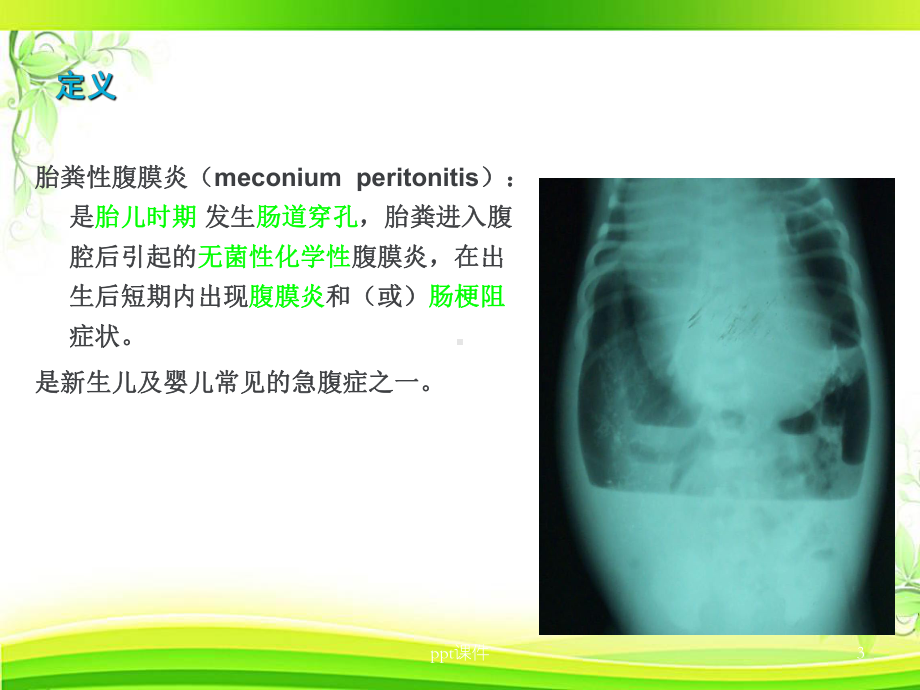 胎粪性腹膜炎-ppt课件.ppt_第3页