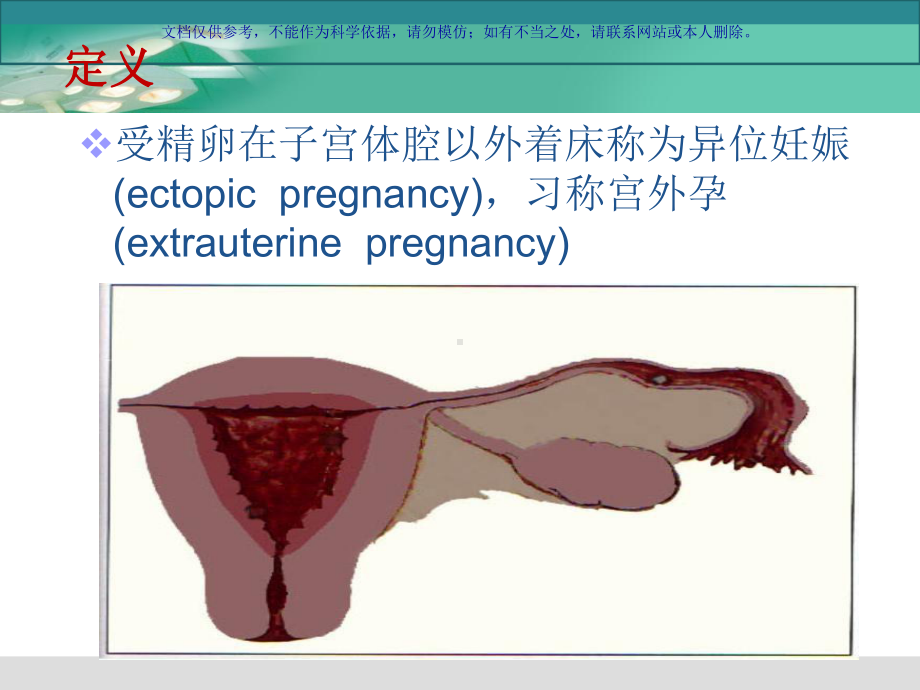 腹腔镜下宫外孕手术的医疗护理配合课件.ppt_第1页