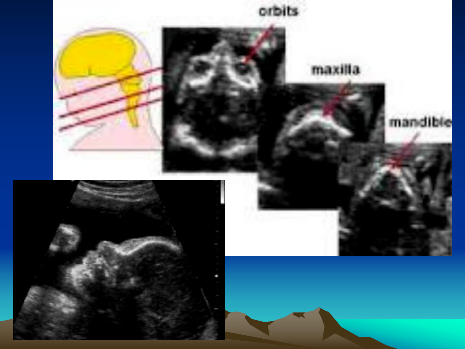 胎儿面部及颈部畸形的超声诊断(1)课件.ppt_第3页