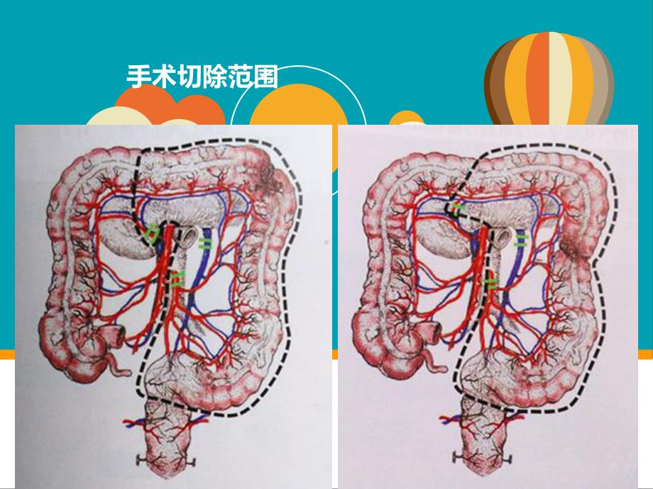 腹腔镜根治性(扩大)左半结肠切除术-ppt课件.ppt_第3页