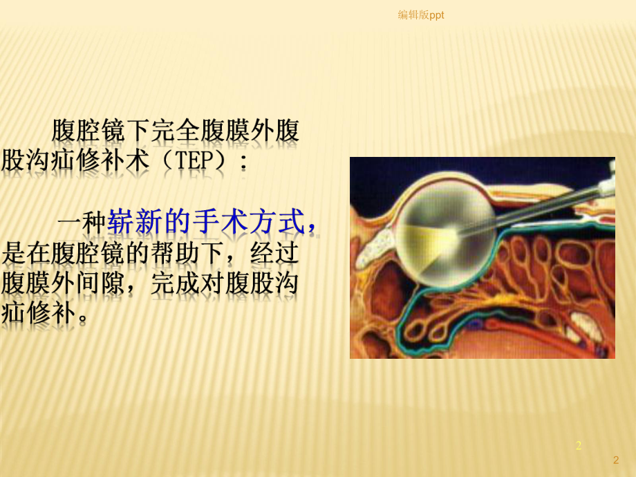 腹腔镜下完全腹膜外腹股沟疝修补术课件.pptx_第2页