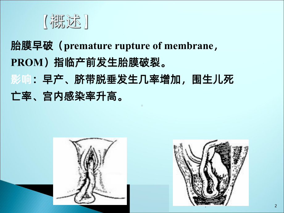 胎膜早破的护理ppt课件1.ppt_第2页