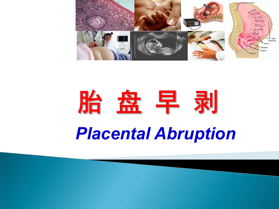 胎盘早剥课ppt课件.ppt_第2页