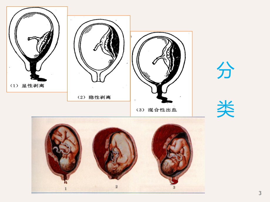 胎盘早剥-ppt课件1.ppt_第3页