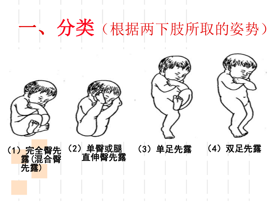 臀位分娩完整版课件.ppt_第2页