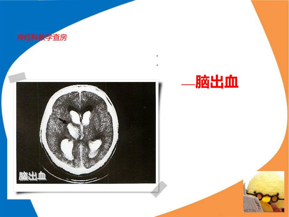 神内-教学查房-脑出血-PPT课件.ppt_第1页