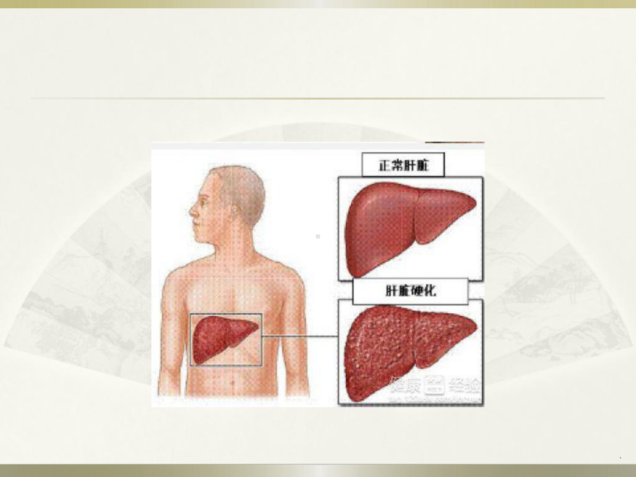 肝硬化腹水病人的护理课件.pptx_第3页