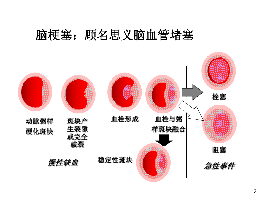 急性脑梗死溶栓治疗PPT课件.ppt_第2页