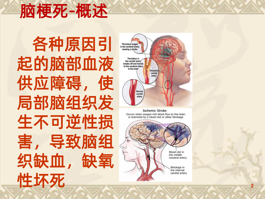 最经典的脑梗死临床表现及治疗PPT课件.ppt_第2页