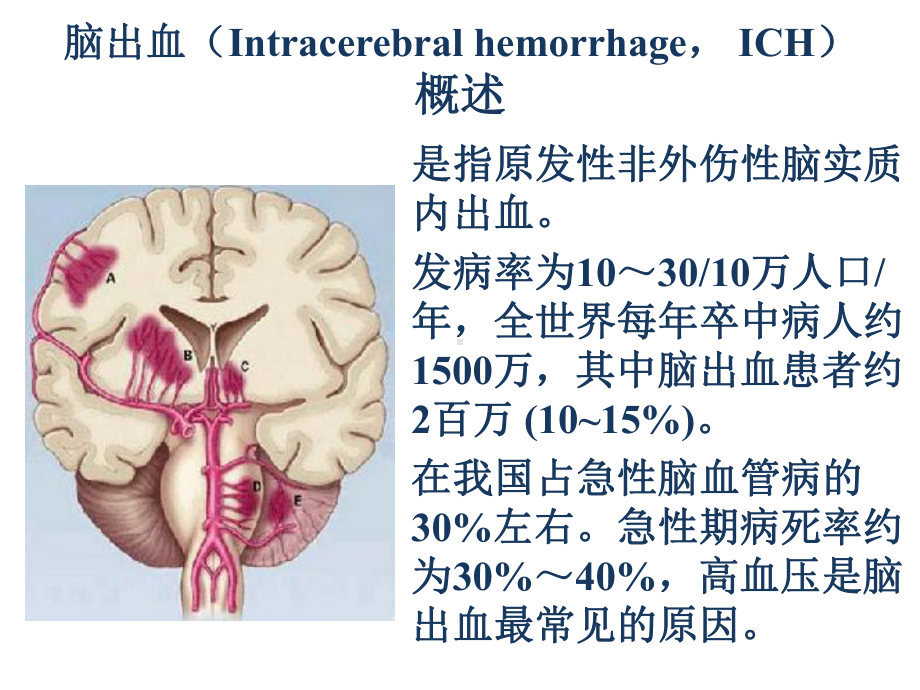 脑出血规范化治疗课件.ppt_第3页