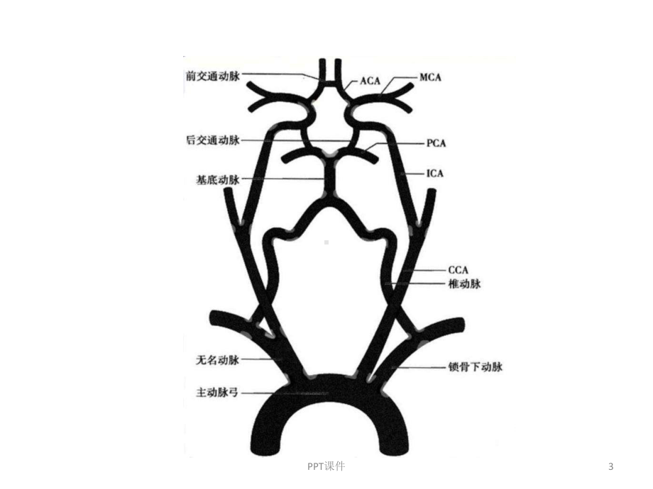 急性缺血性脑卒中血管内介入治疗-ppt课件.ppt_第3页