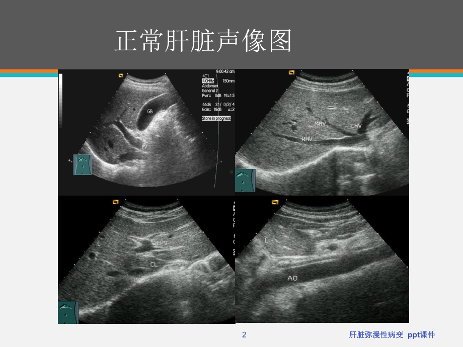 肝脏弥漫性病变-ppt课件.ppt_第2页