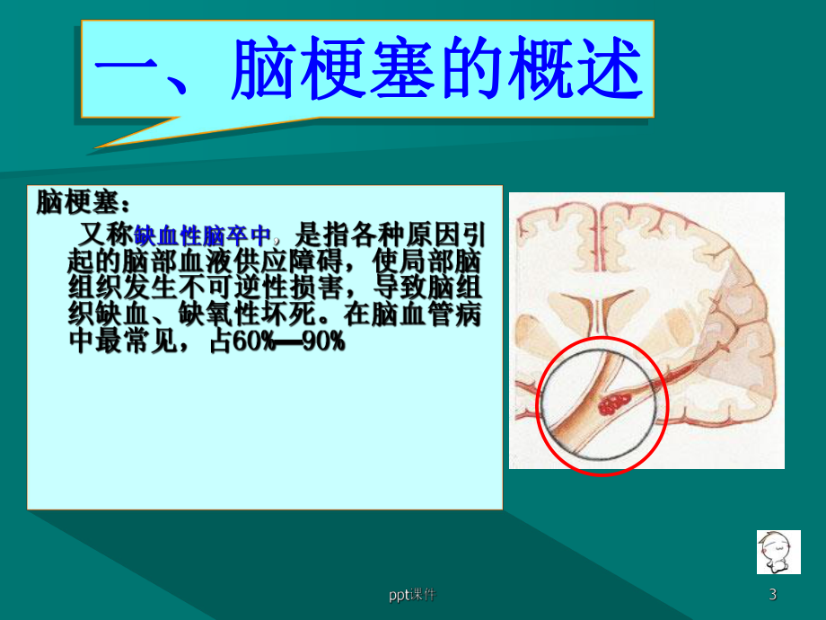 脑梗塞病人的护理查房-ppt课件.ppt_第3页