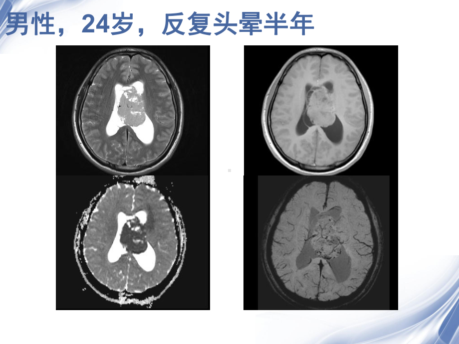 侧脑室肿瘤的鉴别诊断-ppt课件.ppt_第2页