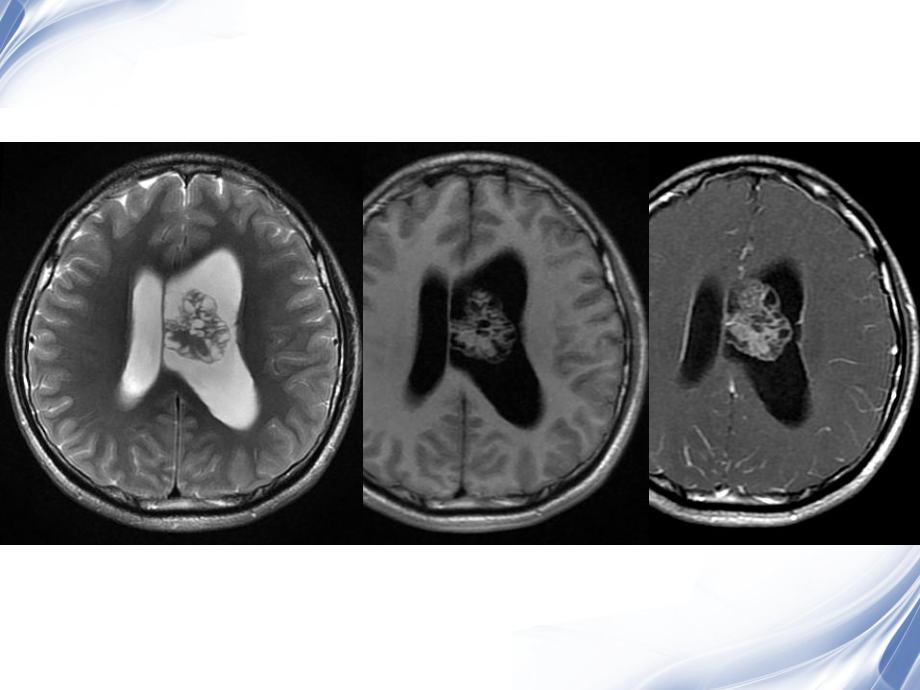 侧脑室肿瘤的鉴别诊断-ppt课件.ppt_第3页