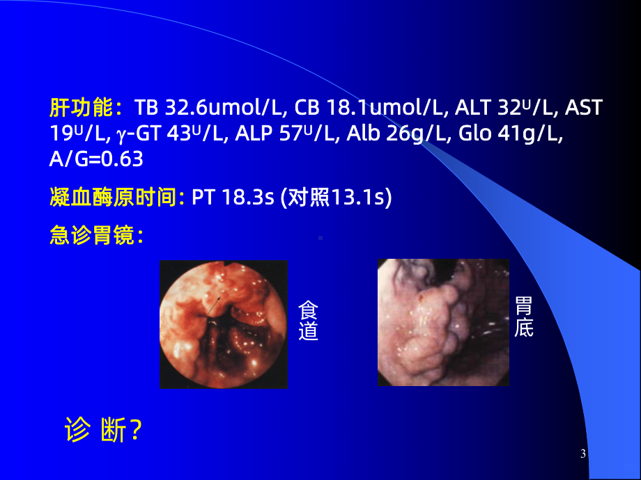 肝硬化教学PPT课件.ppt_第3页