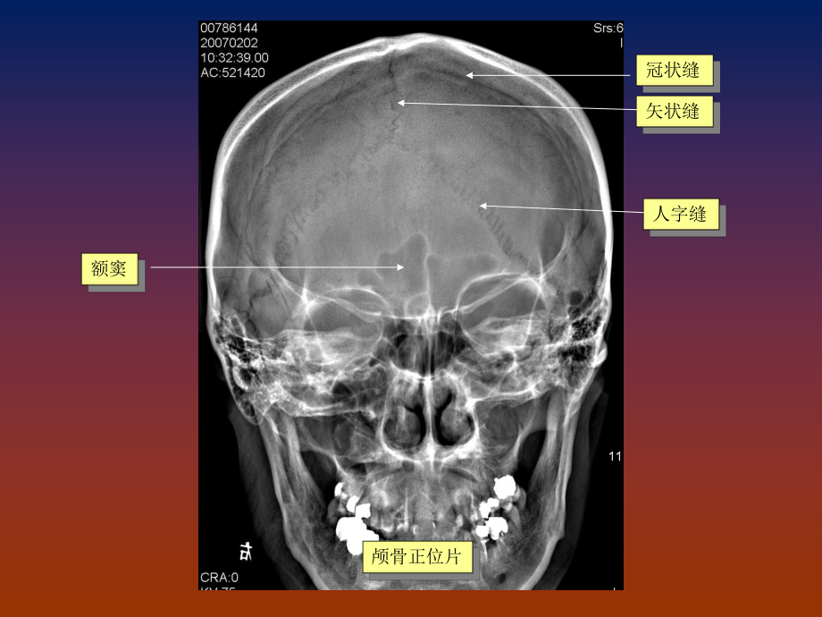 脑血管畸形诊断SPPT课件.pptx_第2页