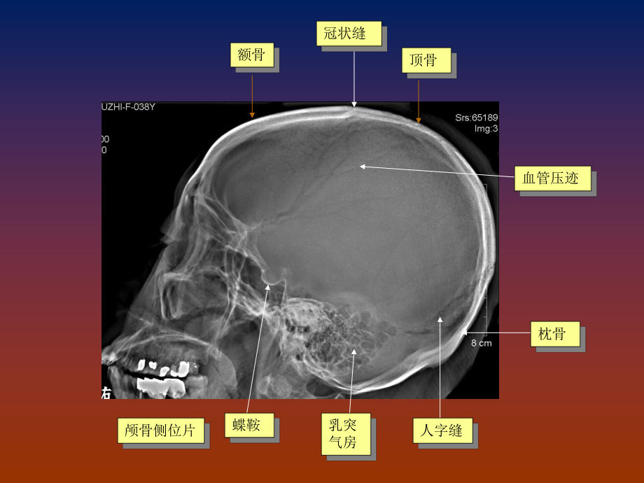 脑血管畸形诊断SPPT课件.pptx_第3页