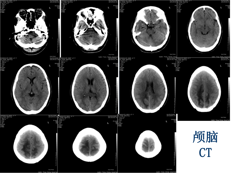 可逆性后部白质脑病综合征(RPLS)课件.ppt_第2页