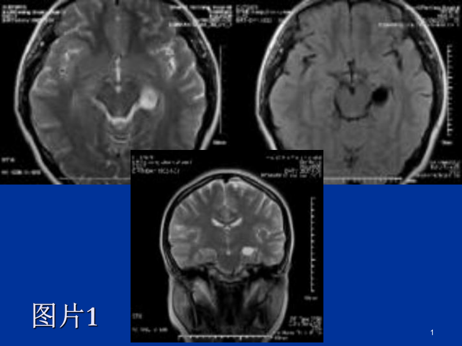 脉络膜裂囊肿&脑血管周围间隙课件.ppt_第1页