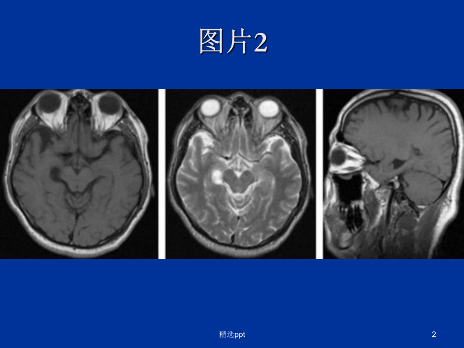 脉络膜裂囊肿&脑血管周围间隙课件.ppt_第2页