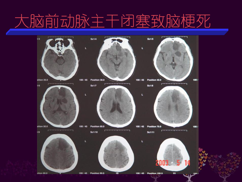 脑梗死责任血管分析-ppt课件.ppt_第2页