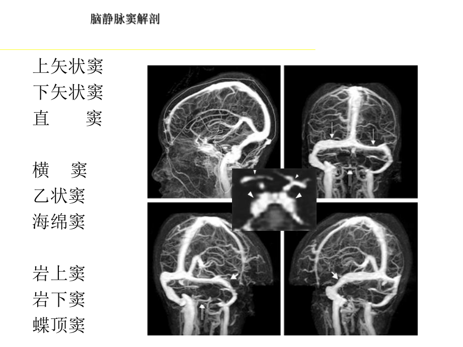 脑静脉和静脉窦血栓形成的影像学诊断(程敬亮)pp课件.ppt_第2页