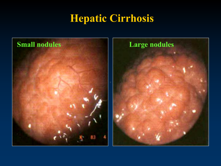 肝硬化诊断和治疗课件.ppt_第2页