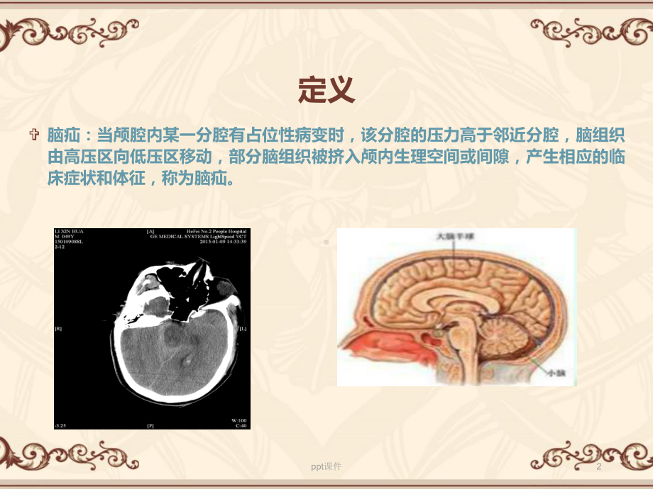 急性脑疝的护理查房-ppt课件.ppt_第2页