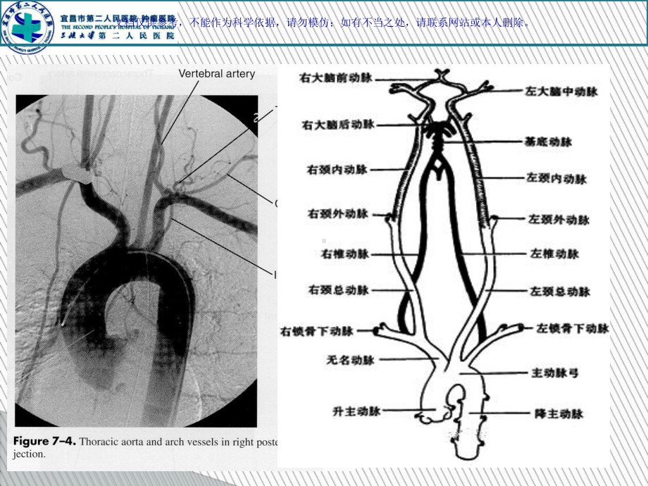 脑血管介入围手术期管理课件.ppt_第2页