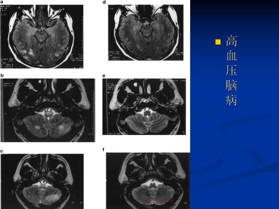 高血压脑病课件.ppt_第3页