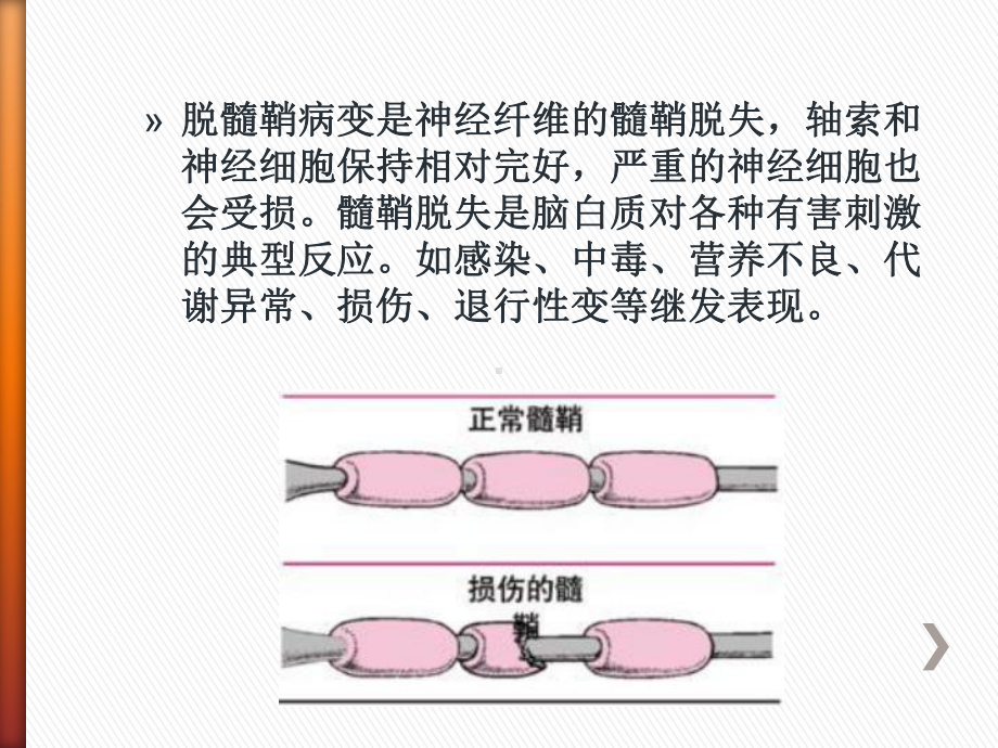 脑脱髓鞘疾病的影像诊断课件.ppt_第3页