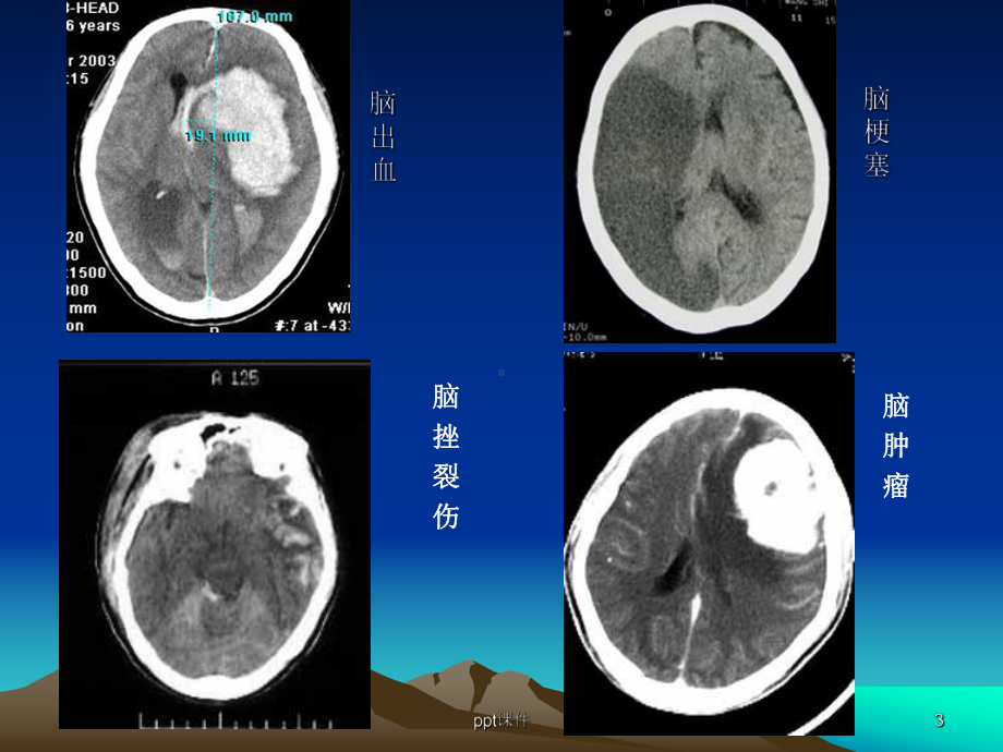 神经外科CT影像基础-ppt课件.ppt_第3页