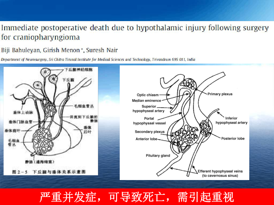 神经外科重症下丘脑损伤后水电解质紊乱参考课件.ppt_第3页