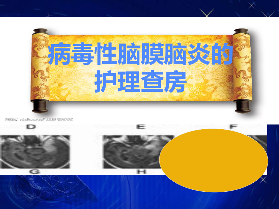 病毒性脑炎护理查房(1)课件.ppt_第1页