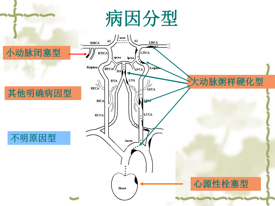 一例缺血性脑卒中病例分析课件.ppt_第3页