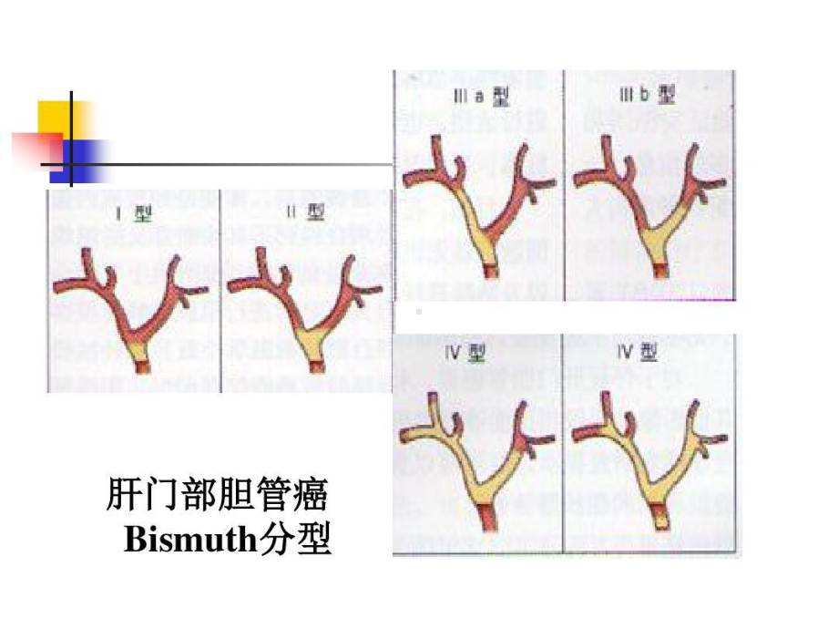 肝门部胆管癌的内镜治疗共42页课件.ppt_第3页