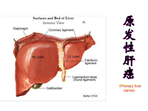 内科护理学原发性肝癌资料课件.ppt