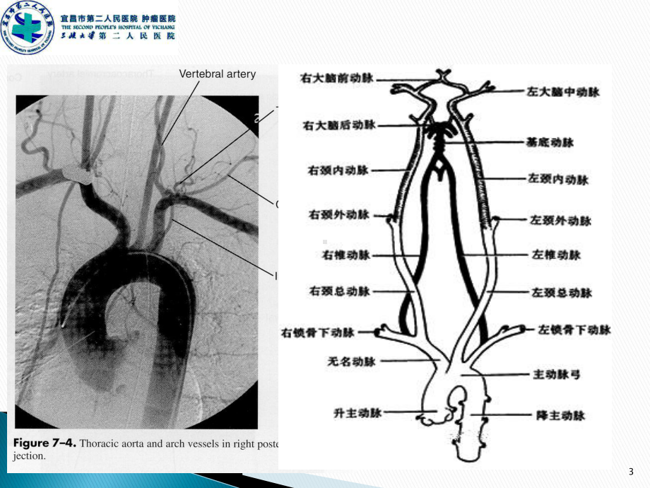 脑血管介入围手术期管理PPT课件.ppt_第3页