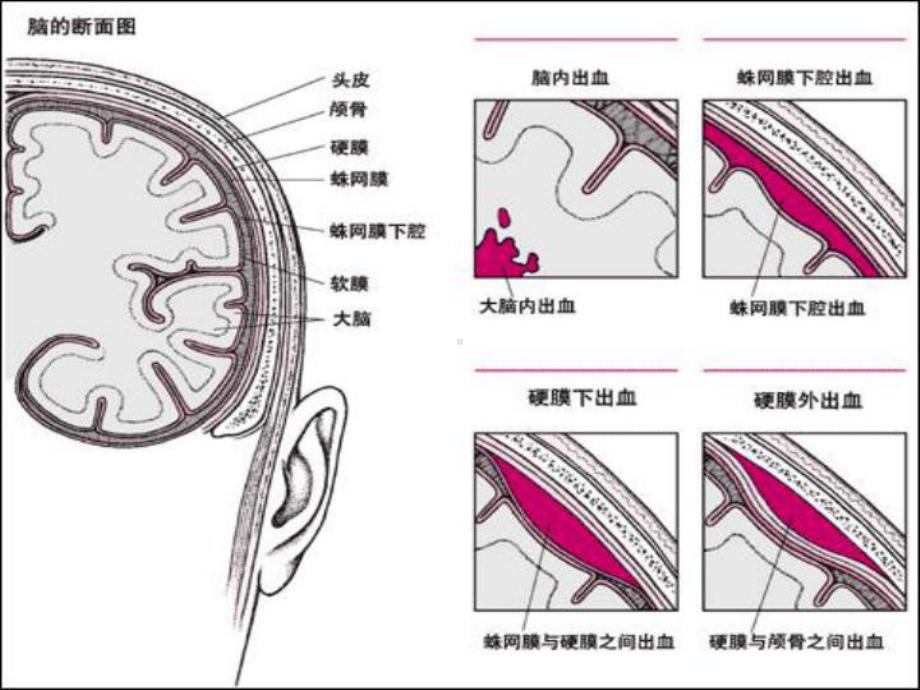 神经外科常见引流管的护理PPT课件.ppt_第2页