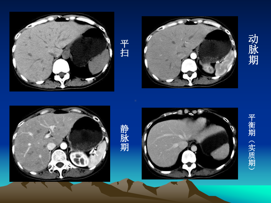 肝段断面影像解剖及临床应用课件.ppt_第3页