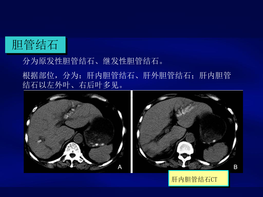 肝胆管结石诊断和治疗共46页课件.ppt_第1页