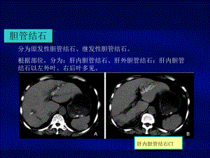 肝胆管结石诊断和治疗共46页课件.ppt