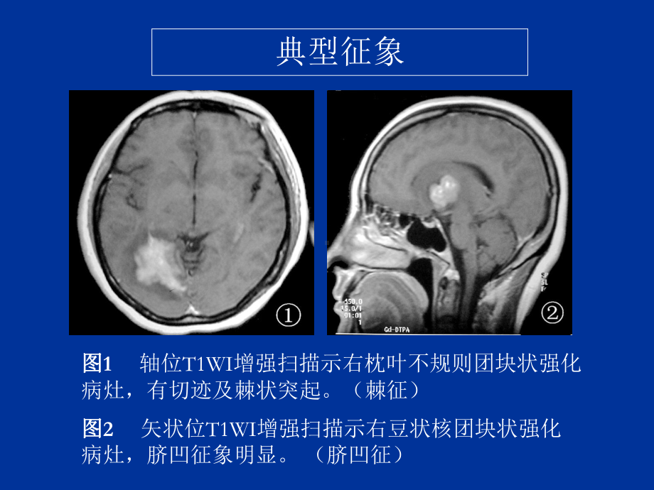 脑部原发性淋巴瘤的MRI诊断课件.ppt_第3页