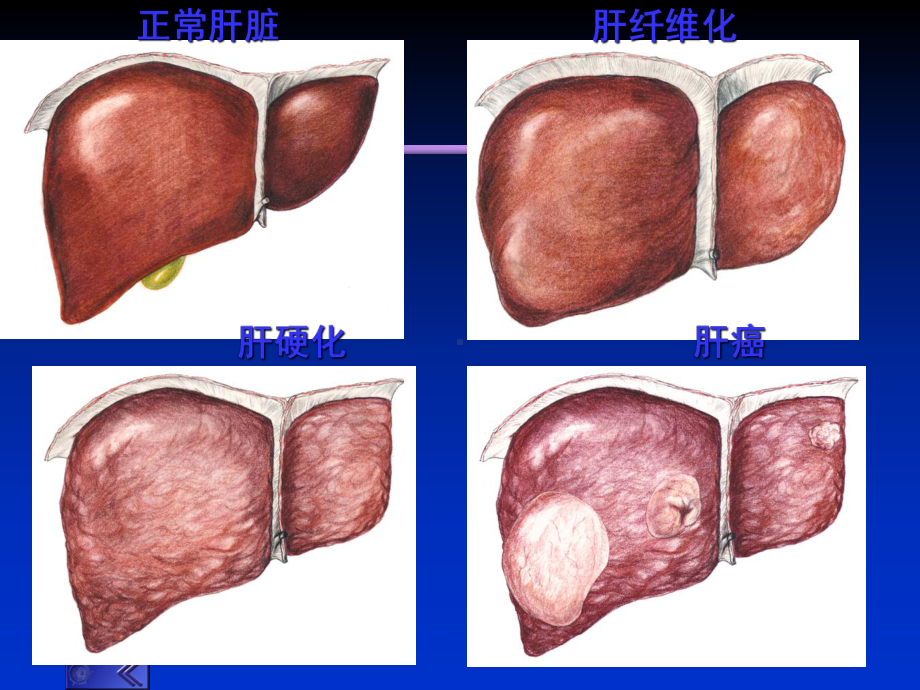 肝硬化诊断及治疗课件.ppt_第2页