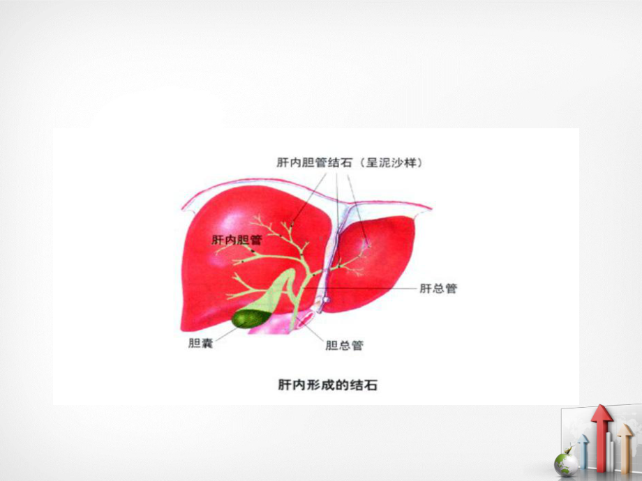 肝内外胆管结石的护理-ppt课件.ppt_第3页